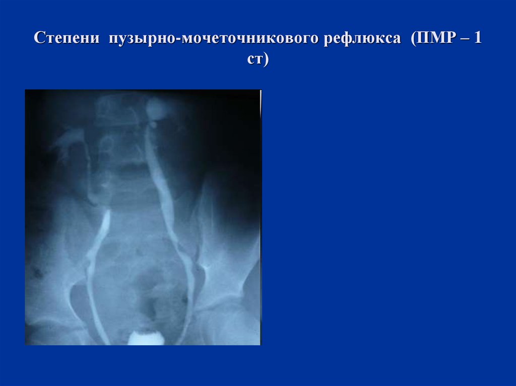 Рефлюкс у детей. Пузырно-мочеточниковый рефлюкс 1 степени. Пузырно мочеточниковый рефлюкс 1 ст. Пузырно-мочеточниковый рефлюкс 1 степени рентген. ПМР пузырно -мочеточникового рефлюкса.