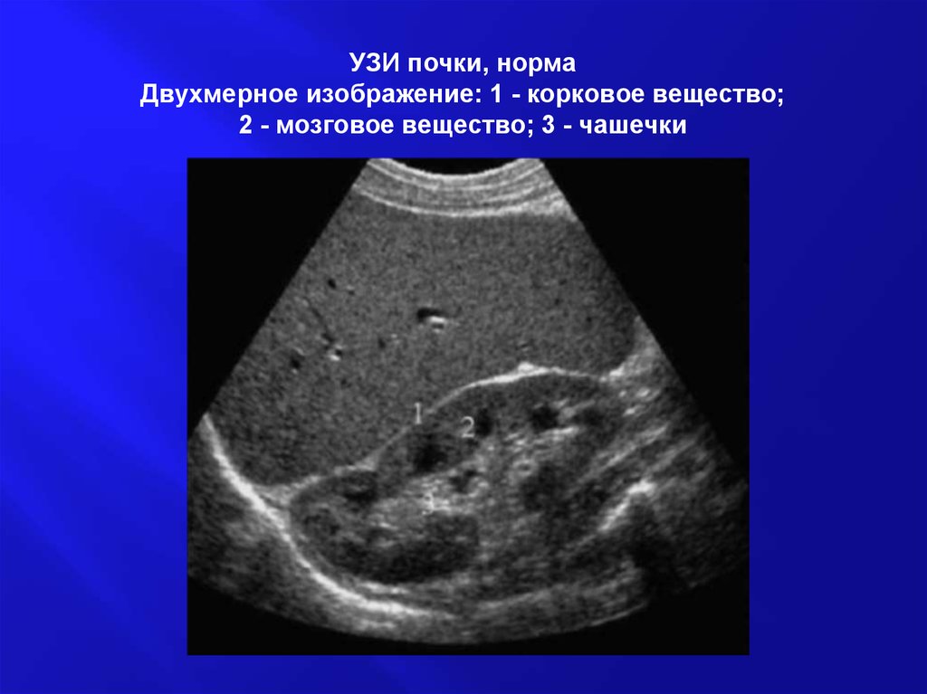 Почках и в головном мозге. Поперечный срез почки УЗИ. Расширение чашечек почки на УЗИ. УЗИ почки на фронтальном срезе. Мозговое вещество почки УЗИ.