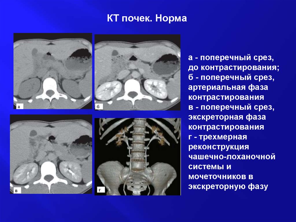 Кт с контрастом почек