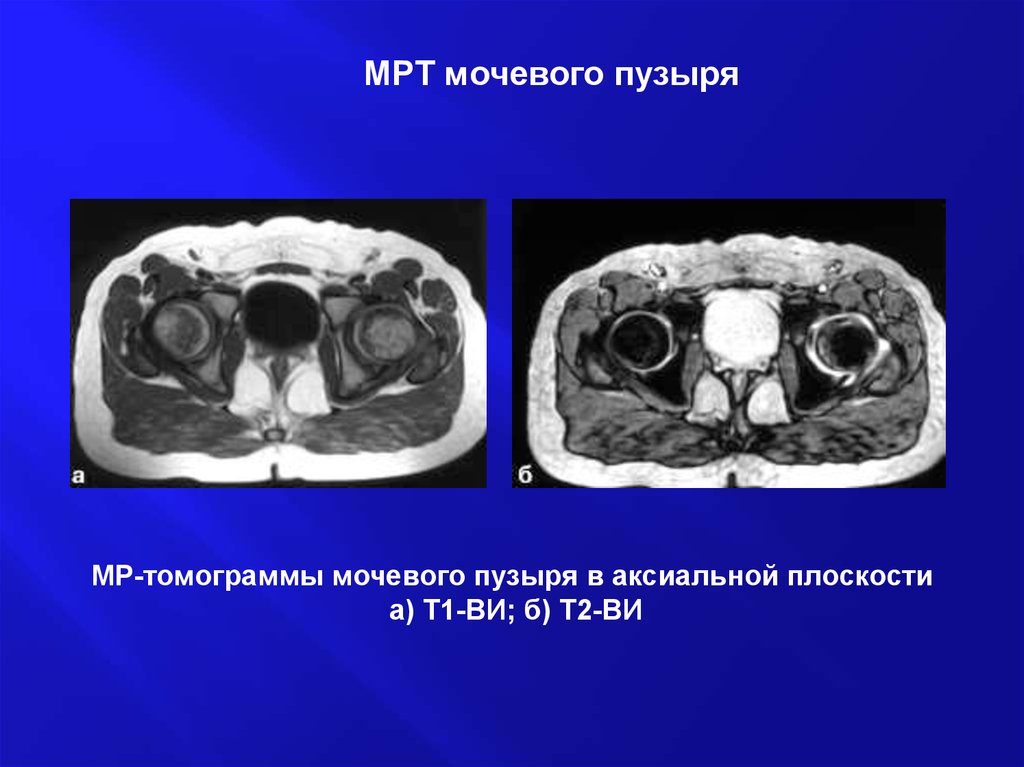 Мрт мочевого пузыря. Т1 ви и т2 ви на мрт. Т1 и т2 мрт разница.