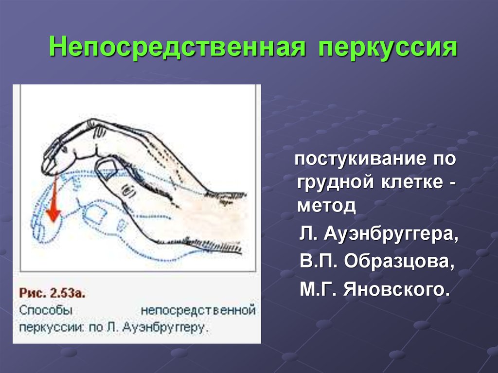 Перкуссия это. Непосредственная перкуссия. Посредственная и непосредственная перкуссия. Непосредственная перкуссия по Ауэнбруггеру. Преимущества посредственной перкуссии.