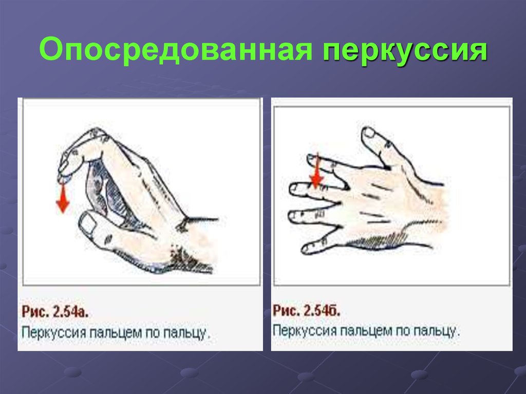 Перкуссия это. Опосредованная перкуссия. Пальце пальцевая перкуссия. Непосредственная и опосредованная перкуссия. Непосредственная и опосредованная перкуссия лёгких.