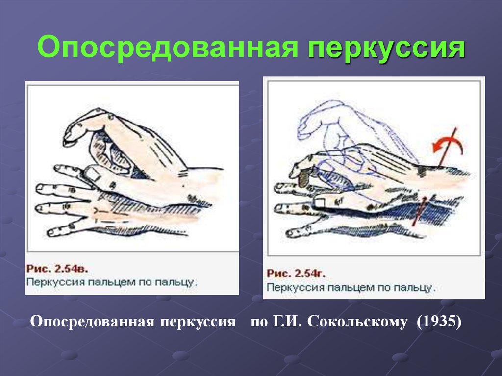 Перкуссия это. Опосредованная перкуссия. Непосредственная и опосредованная перкуссия. Перкуссия по сокольскому. Перкуссия положение пальцев.