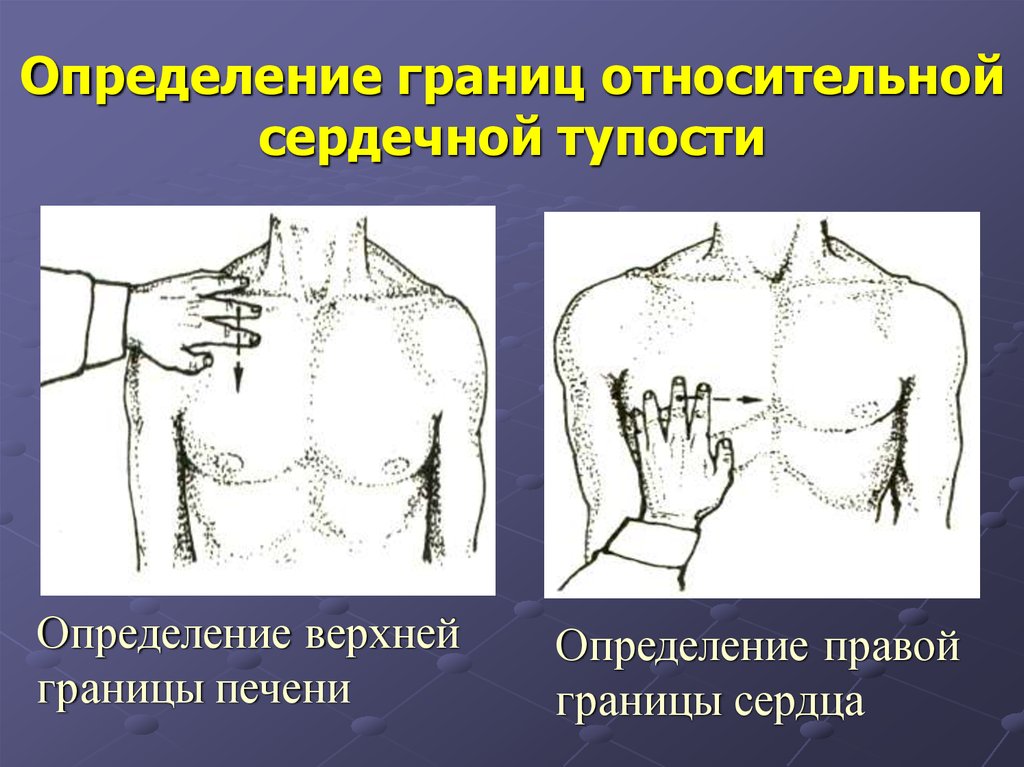 Определить границы. Перкуссия границ относительной сердечной тупости. Границы относительной тупости сердца перкуссия. Перкуссия правой границы относительной сердечной тупости. Перкуссия сердца границы относительной сердечной тупости.