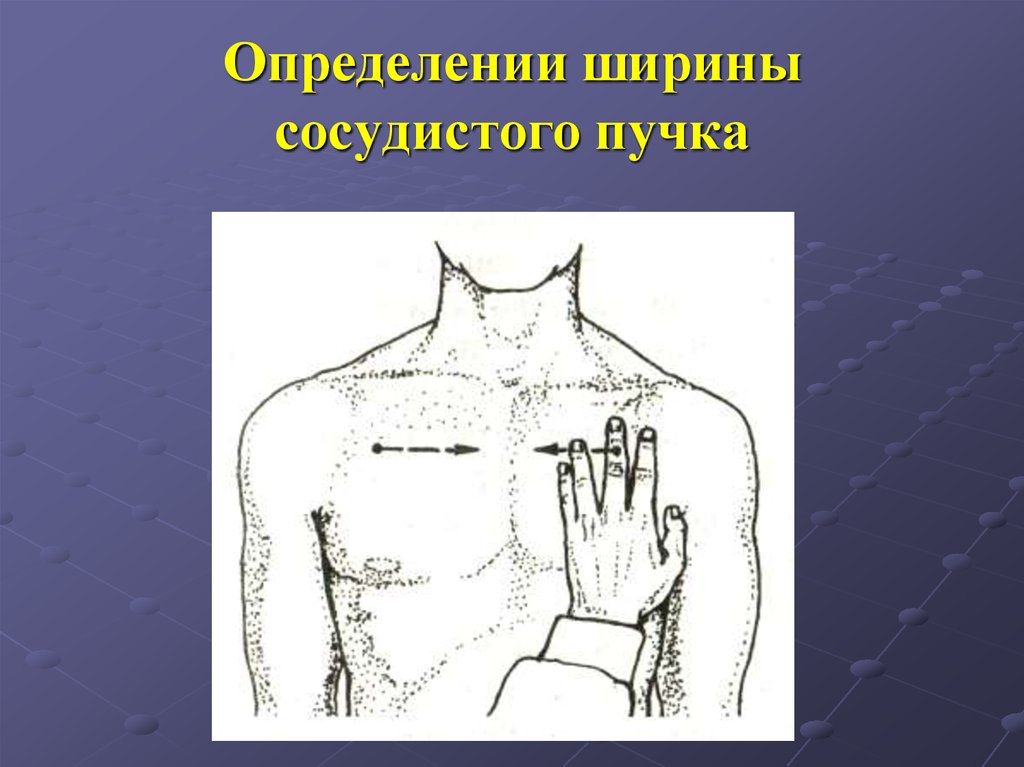 Ширина пучка. Измерение поперечника сердца и ширины сосудистого пучка.. Ширина сосудистого пучка. Ш Рина сосудистого пучка. Перкуссия сосудистого пучка.