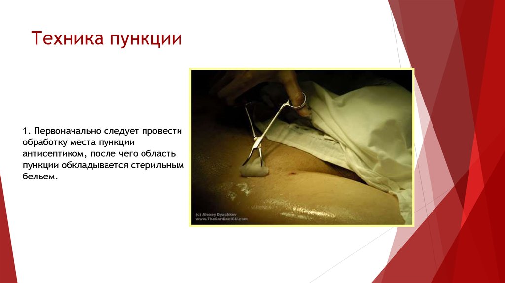 Техника пункции