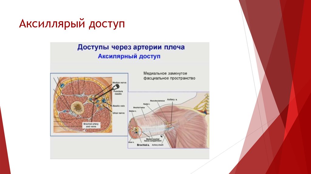 Аксиллярый доступ