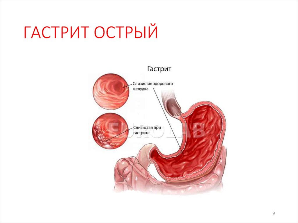 Презентация на тему гастрит