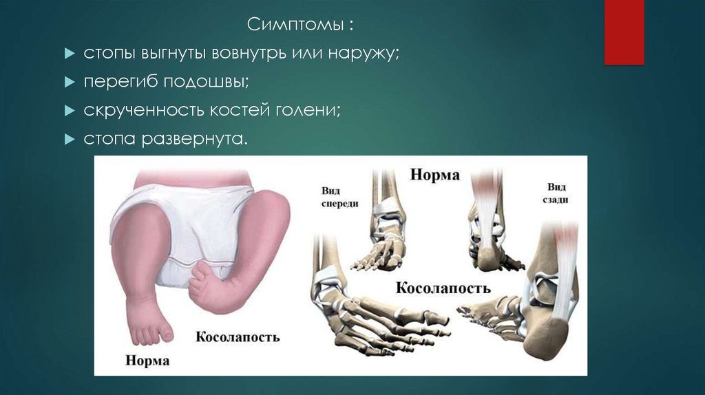 Стопу развернуло наружу. Врожденная косолапость патогенез.