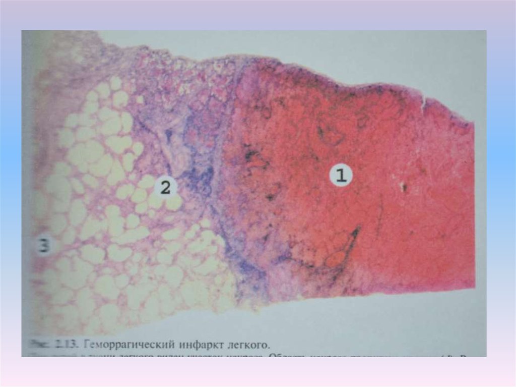 Инфаркт легкого. Геморрагический инфаркт легкого микропрепарат. Геморрагический инфаркт легкого гистология. Геморрагический инфаркт легкого патанатомия. Геморрагический инфаркт легких микропрепарат.