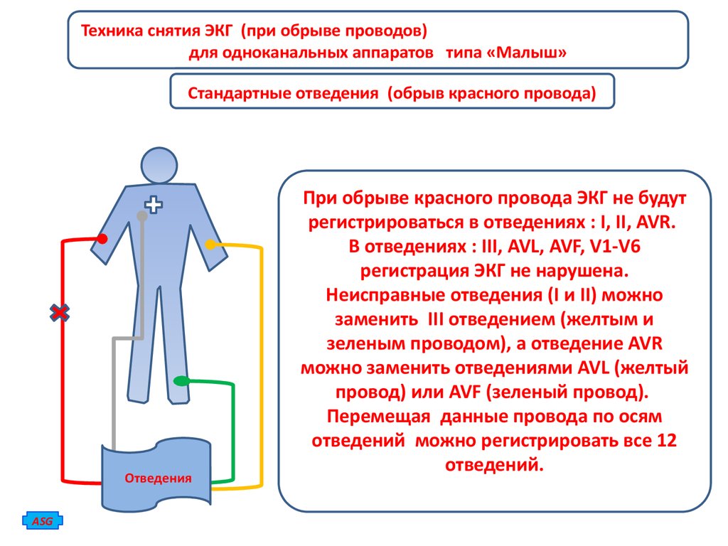 Техника снятия ЭКГ (при обрыве проводов) для одноканальных аппаратов типа  «Малыш» - презентация онлайн