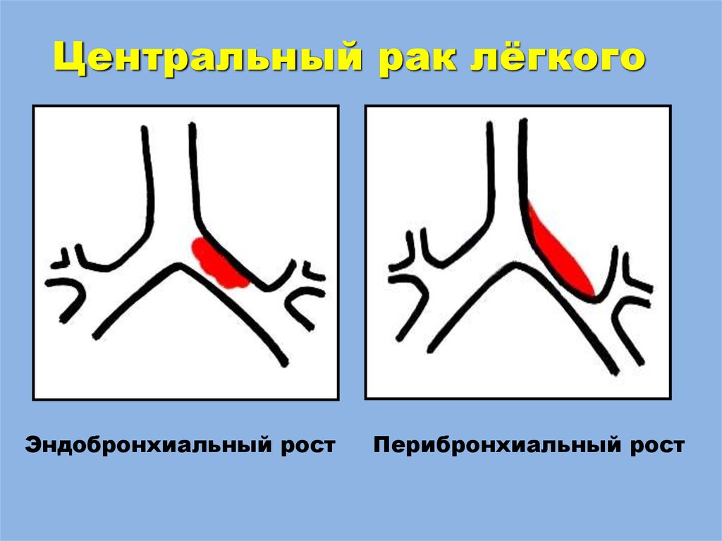Центральный рак лёгкого