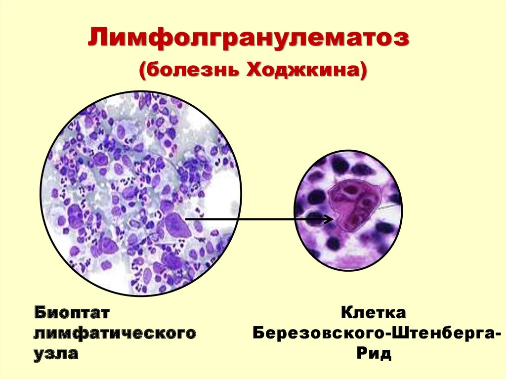 Лимфолгранулематоз (болезнь Ходжкина)