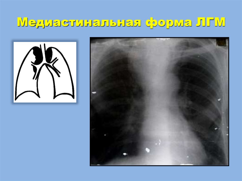 Кальцинаты в лимфоузлах. Лимфоузлы средостения рентген. Симптом дымовой трубы рентген. Туберкулез внутригрудных лимфатических узлов кт. Туберкулез внутригрудных лимфатических узлов рентген.