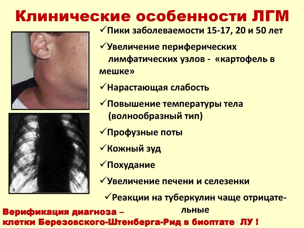 Клинические особенности ЛГМ