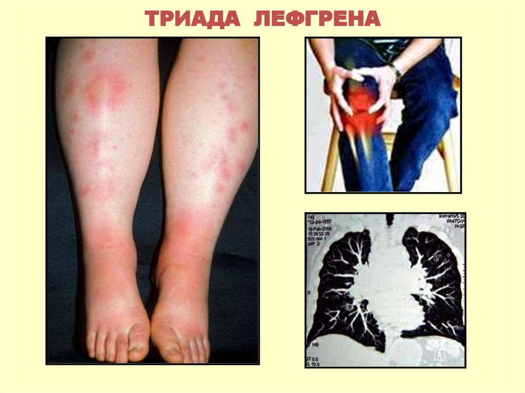 ТРИАДА ЛЕФГРЕНА