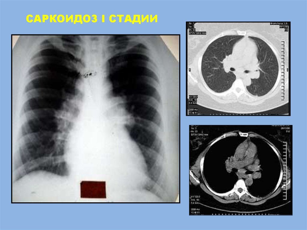 Аденопатия. Саркоидоз 2 стадии рентген. Саркоидоз внутригрудных лимфатических узлов рентген. Медиастинально-легочный саркоидоз. Саркоидоз внутригрудных лимфоузлов рентген.