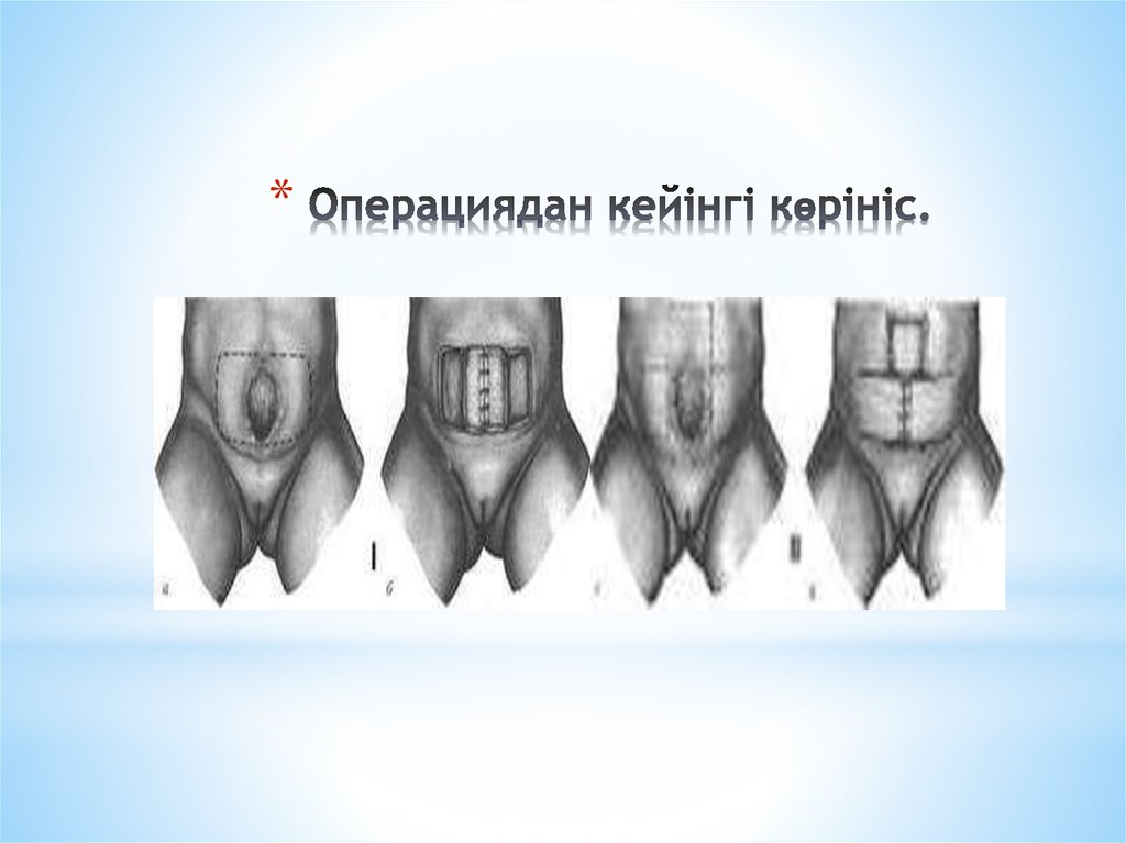 Операциядан кейінгі көрініс.