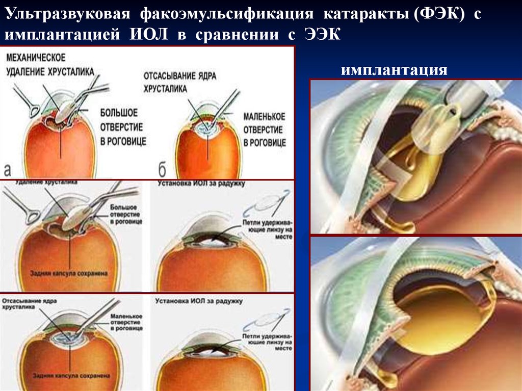 Замена хрусталика глаза как проходит операция. Факоэмульсификация катаракты Разделение ядра. Ультразвуковая факоэмульсификация с имплантацией ИОЛ. Катаракта ФЭК этапы операции. Этапы операции факоэмульсификации катаракты.