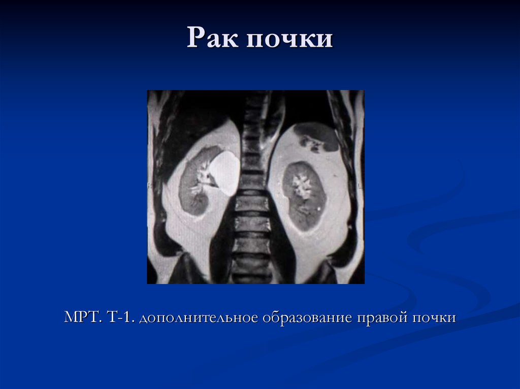 Лучевая диагностика почек презентация