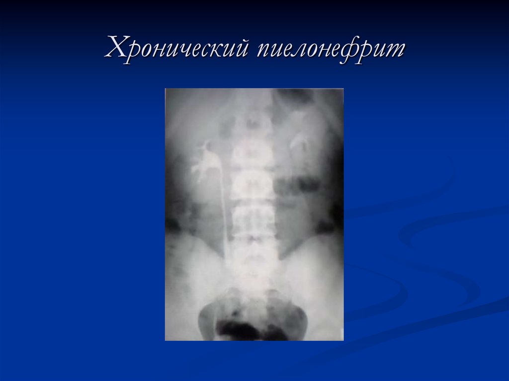 Лучевая диагностика почек презентация