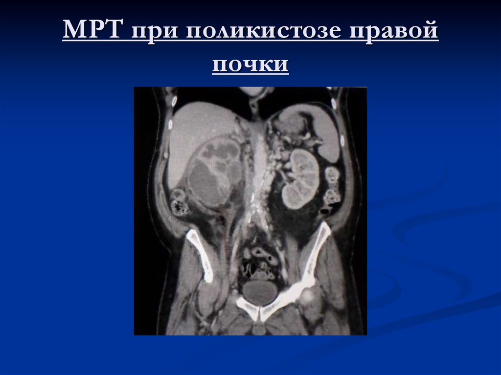 МРТ при поликистозе правой почки