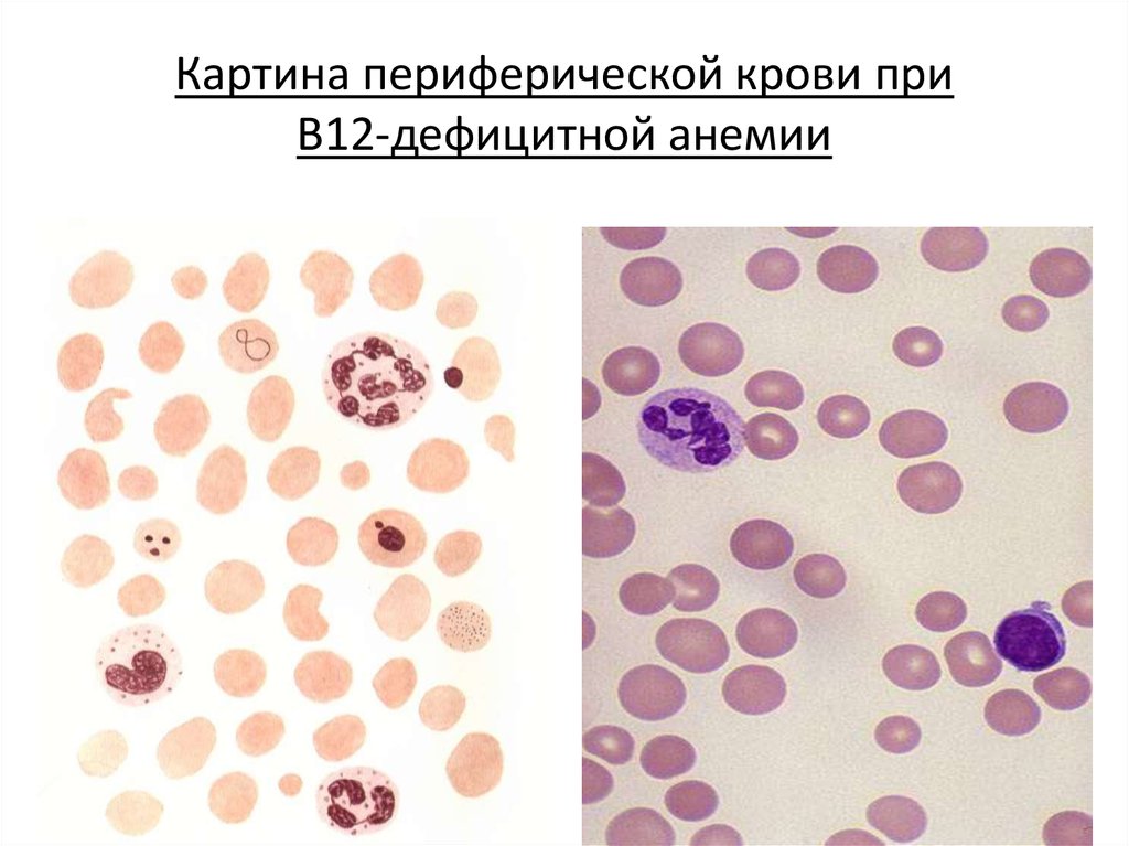 Картина крови при фолиеводефицитной анемии