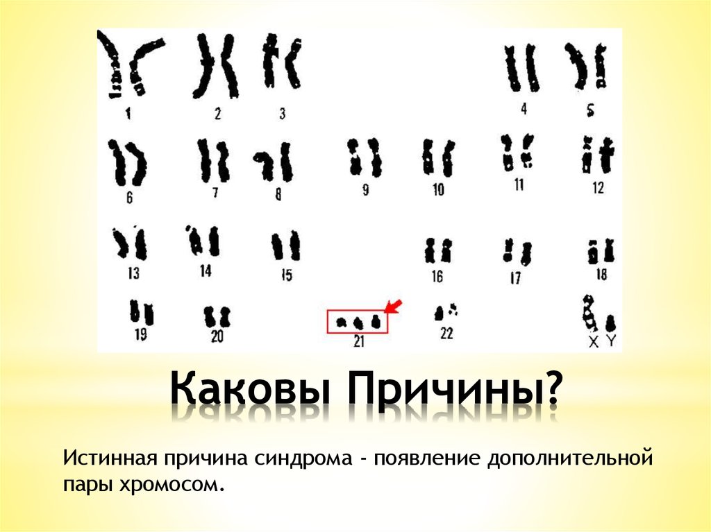 Появление дополнительной хромосомы. Пары хромосом. Дополнительная пара хромосом. Сколько пар хромосом у человека. Синдром Дауна хромосомы.