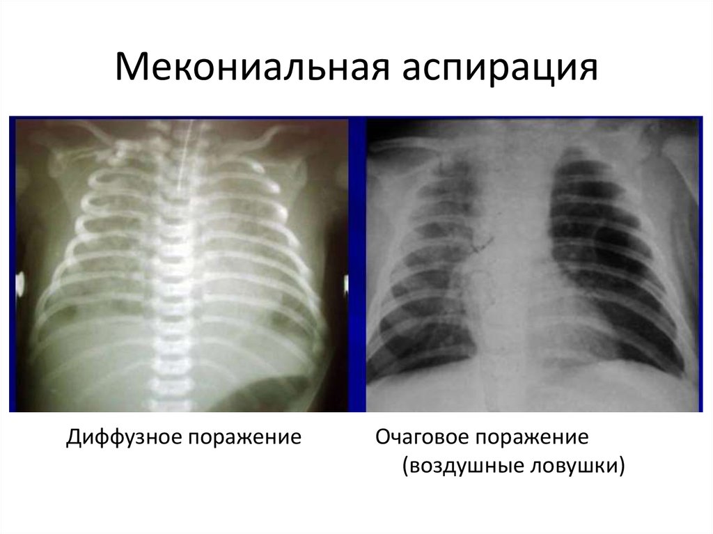 Аспирационная пневмония. Синдром мекониальной аспирации. Аспирационный синдром у новорожденных рентген. Синдром аспирации мекония рентген. Синдром аспирации мекония у новорожденных.