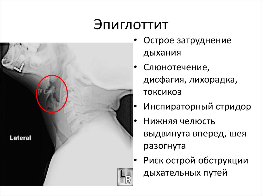 Затрудненное дыхание в шее