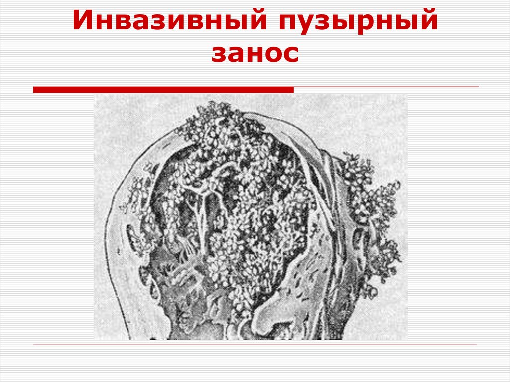 Мкб пузырный занос. Метастатический пузырный занос. Деструирующий пузырный занос клиника. Трофобластическая болезнь пузырный занос. Инвазивный пузырный занос характеризуется:.