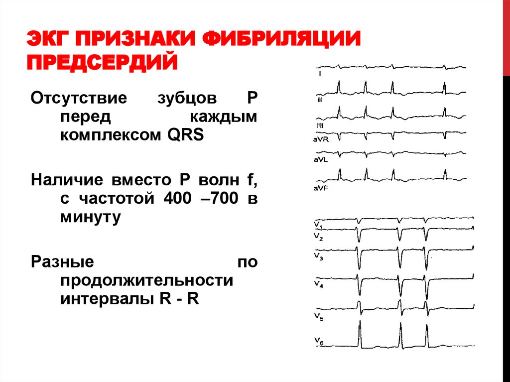 Фибрилляция предсердий картинки