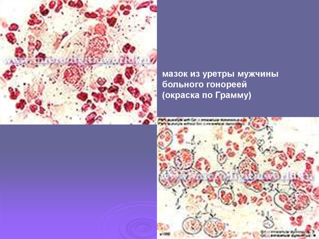 Мазок из уретры у мужчин. Гонококки окраска по грамму. Гонококки в мазке по грамму. Гонорея по окраске по грамму.