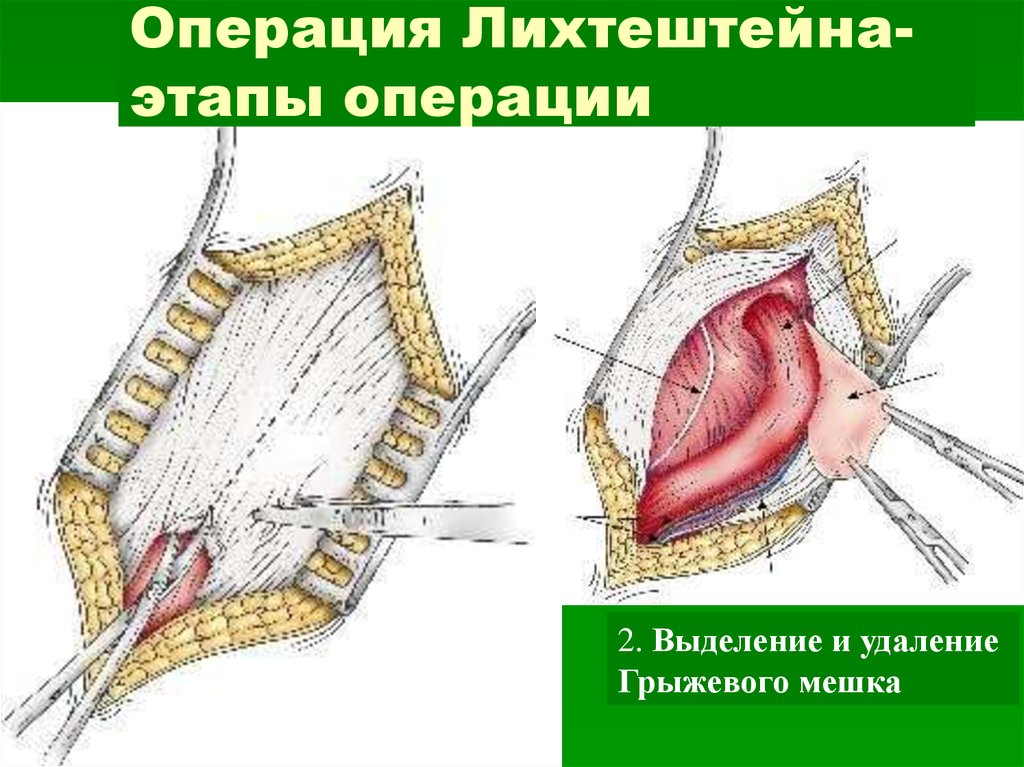 Способы пластики грыж