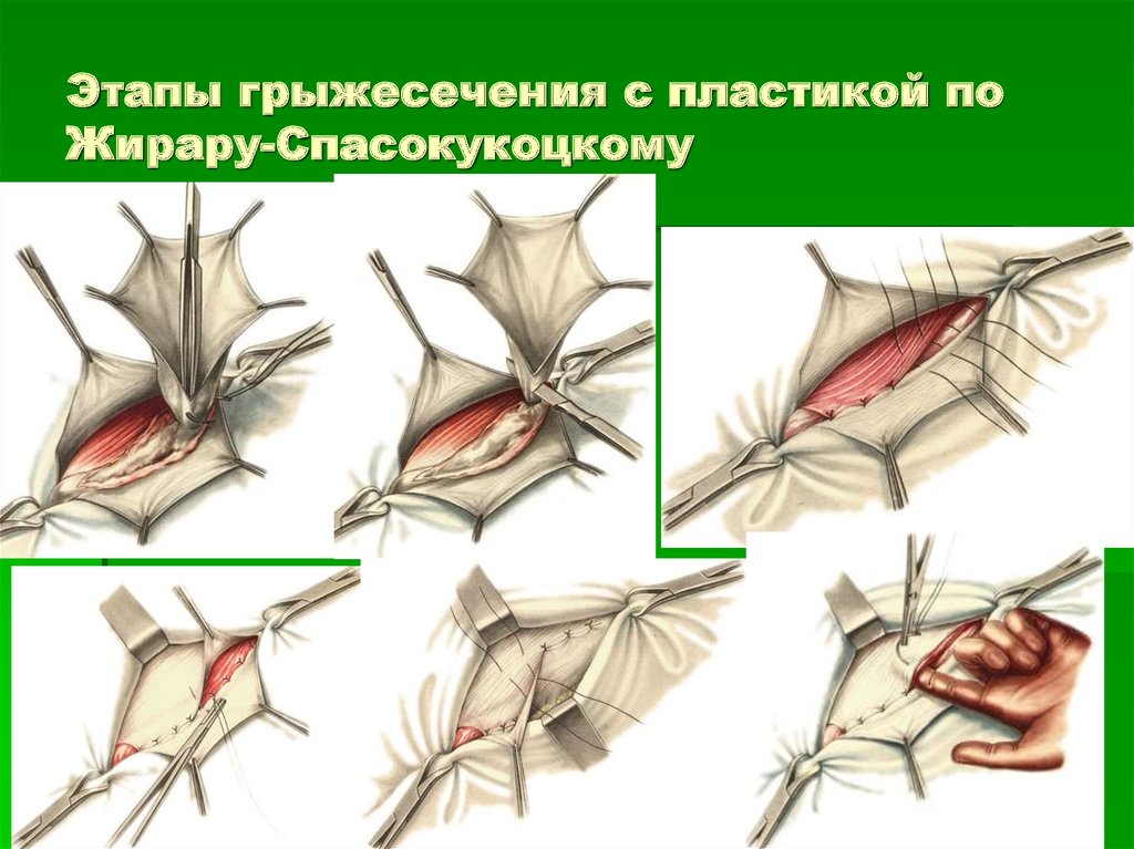 Стол при паховой грыже