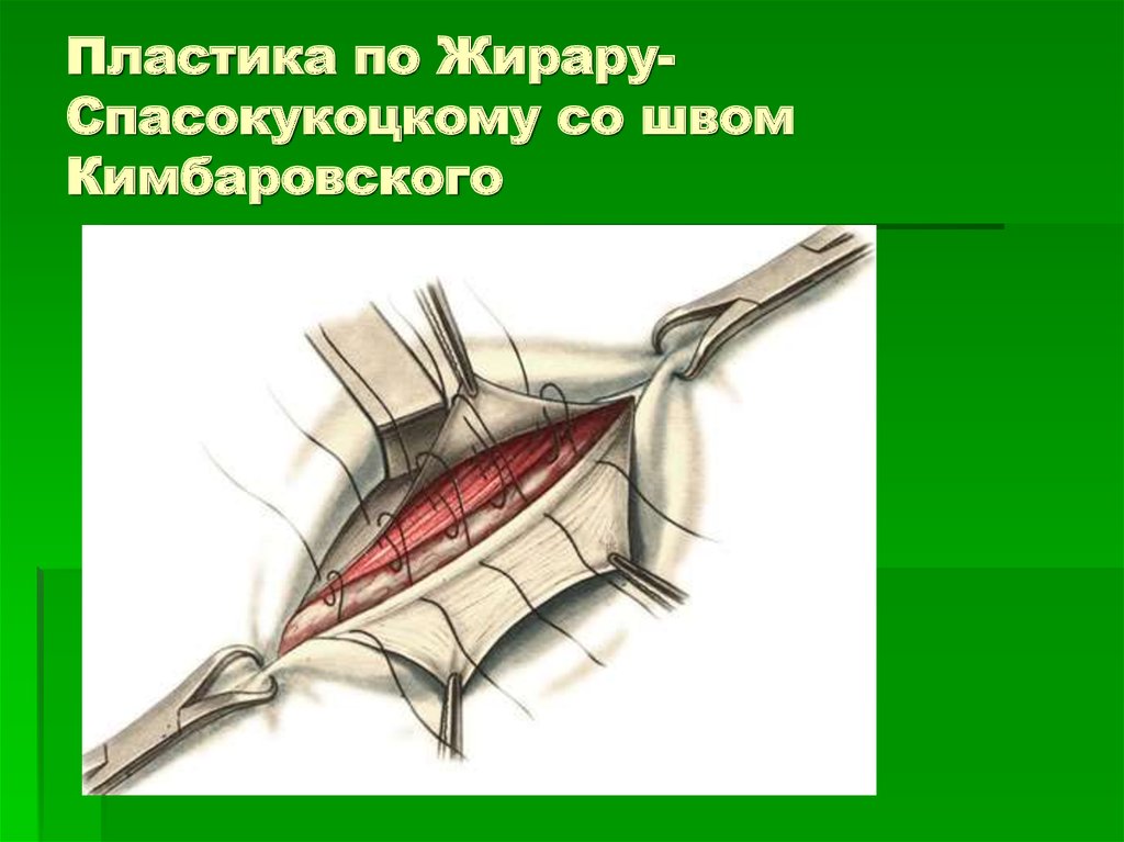 Пластика пахового канала по жирару спасокукоцкому