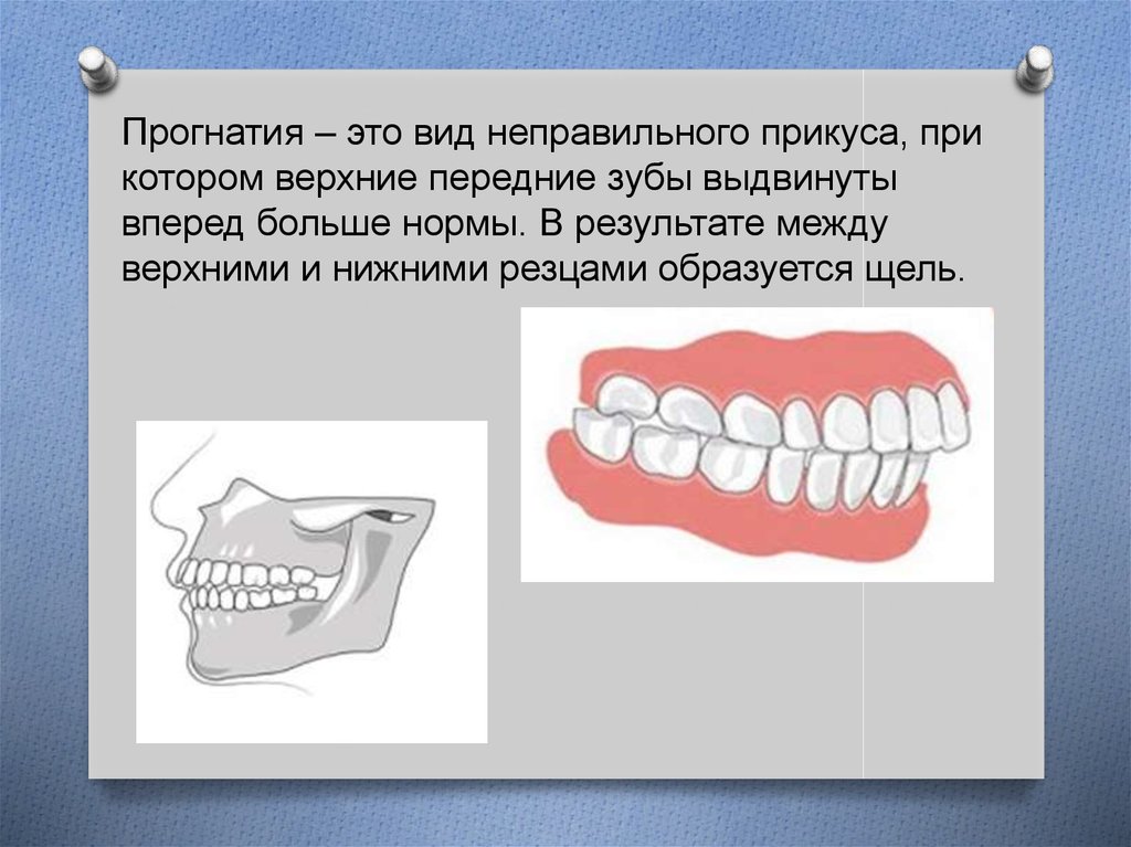 Зубы при закрытом рте. Прогнатия верхней и нижней челюсти.