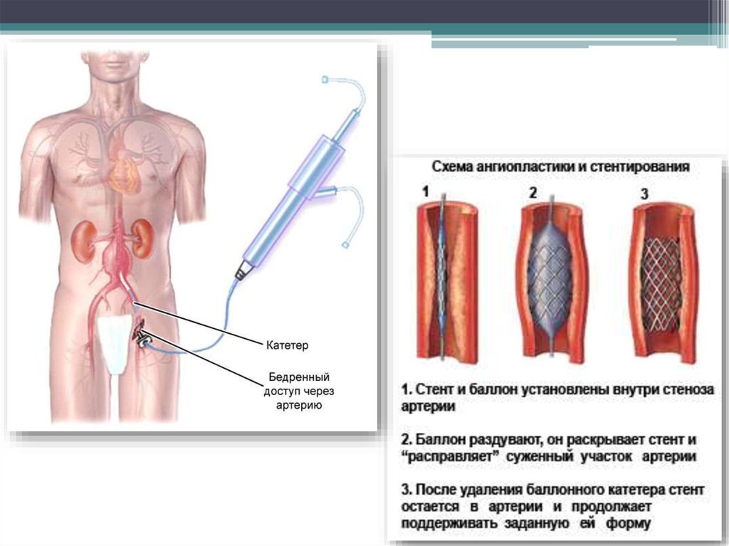 Катетеризация бедренной. Катетер для стентирования. Стент бедренной артерии. Катетер в бедренную артерию. Катетер через бедренную артерию.