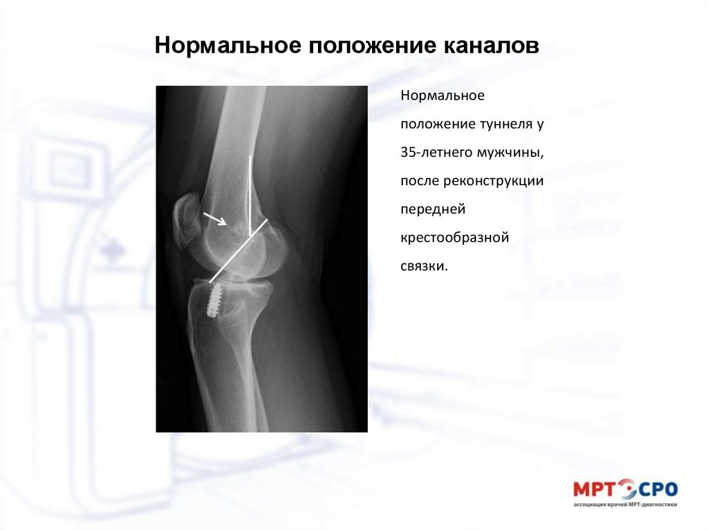 Субтотальный разрыв передней крестообразной связки