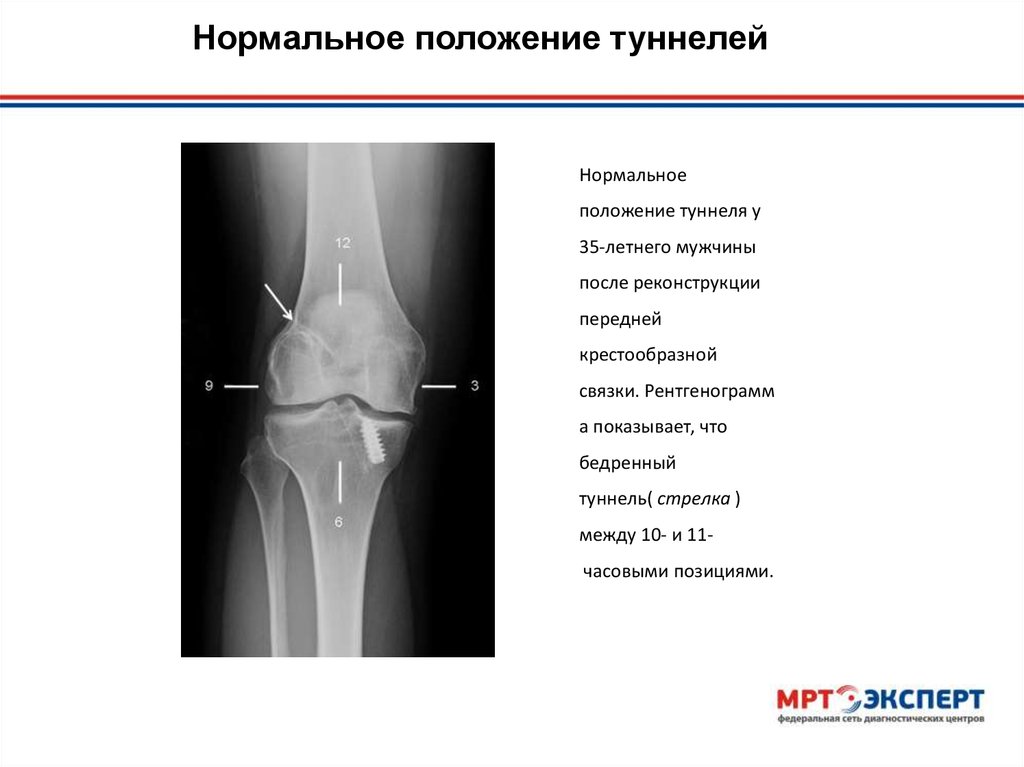 После пластики пкс сколько. Рентгенография пластики крестообразных связок суставов. Реконструкция передней крестообразной связки мрт.