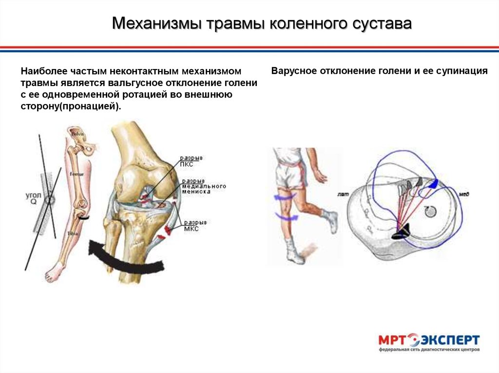 Повреждение коленной связки симптомы. Повреждения коленного сустава травматология. Механизм повреждения коленного сустава. Механизм повреждения менисков. Механизм повреждения менисков коленного сустава.