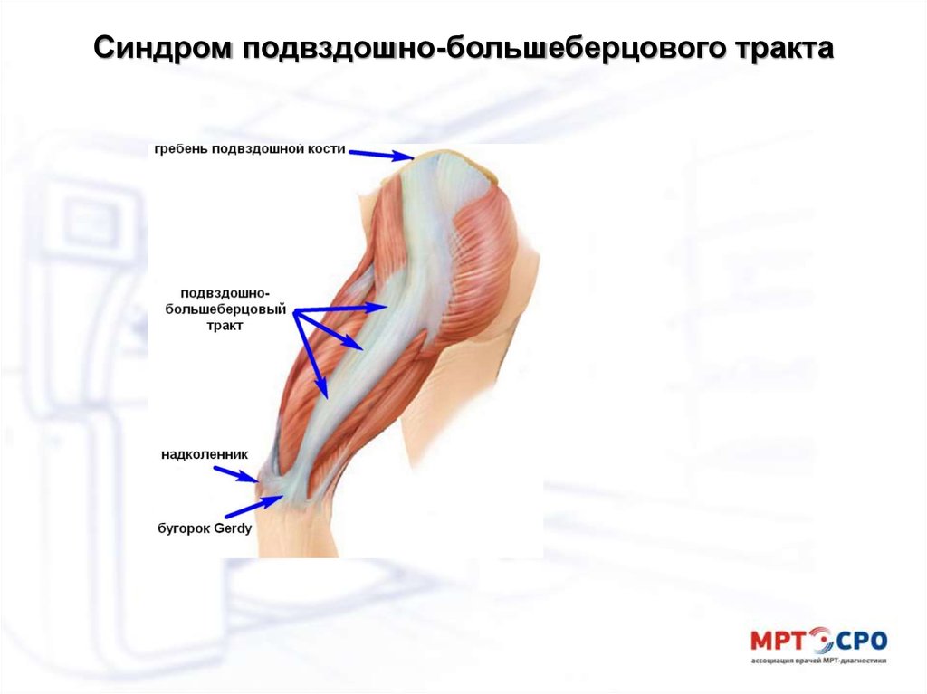 Подвздошно большеберцовый тракт. Илиотибиальный тракт синдром. Большеберцовый тракт анатомия. Синдром бегуна колено илиотибиального тракта. Илиотибиальный тракт анатомия.