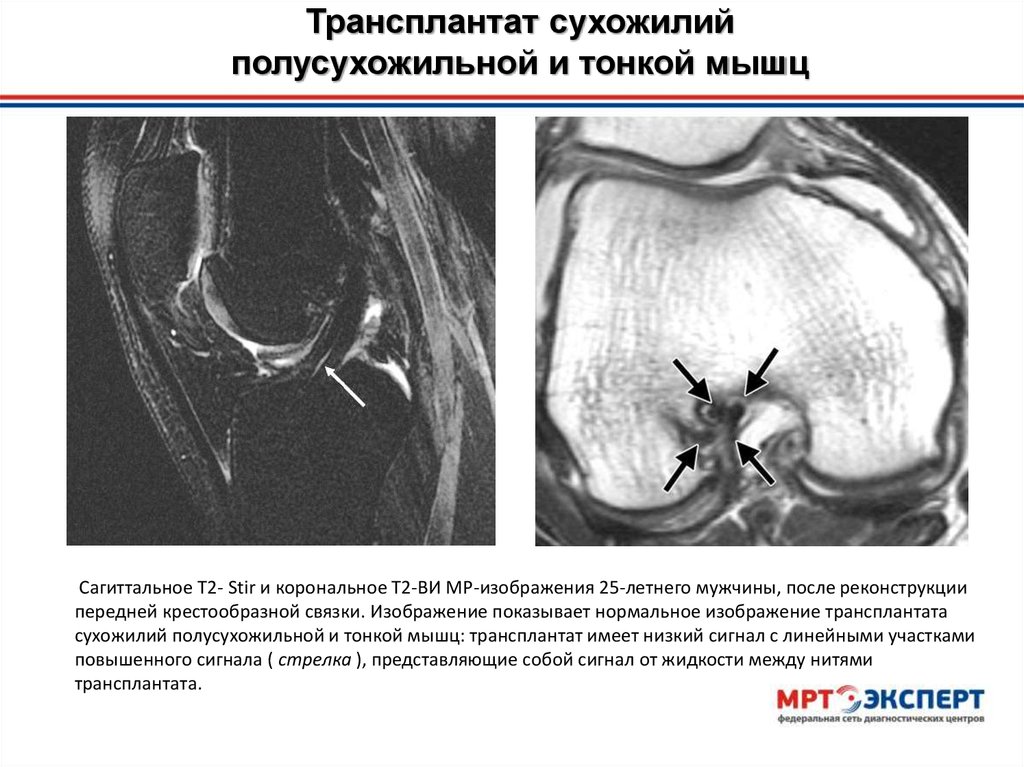 После пластики передней крестообразной связки