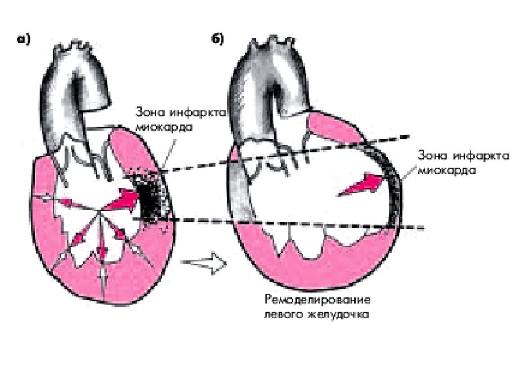 Миокард правого желудочка сердца. Инфаркт левого желудочка сердца. Ремоделирование при инфаркте миокарда. Расслоение миокарда левого желудочка. Трансмуральный инфаркт миокарда левого желудочка.