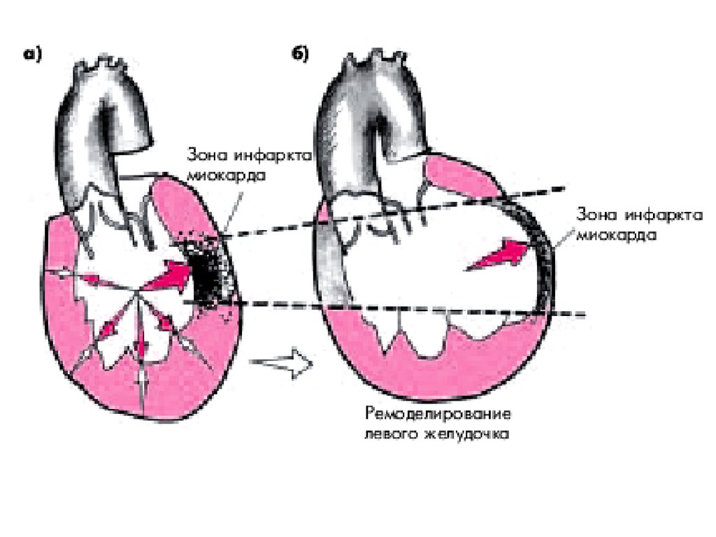 Миокарда левого желудочка. Ремоделирование миокарда после инфаркта. Инфаркт миокарда левого желудочка. Ремоделирование левого желудочка при инфаркте миокарда. Инфаркт миокарда ремоделирование левого желудочка.