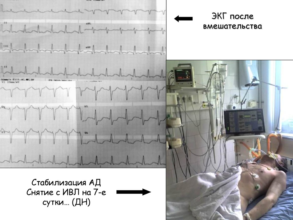 Экг после. ЭКГ после операции.