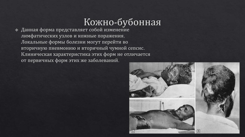 Кожно-бубонная