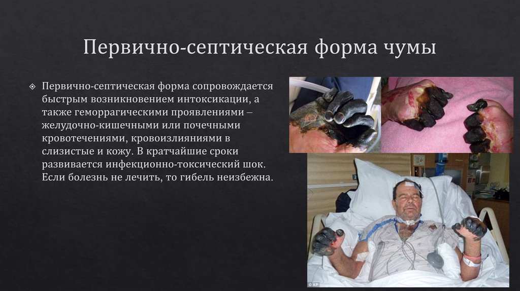 Первично-септическая форма чумы