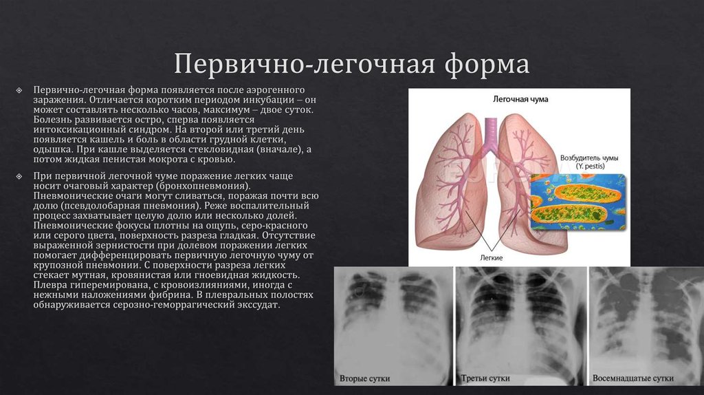 Первично-легочная форма