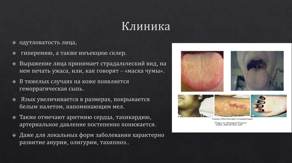 Чума. Симптомы. Клиника. Лечение - презентация онлайн